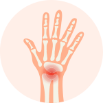 Rheumatoid arthritis